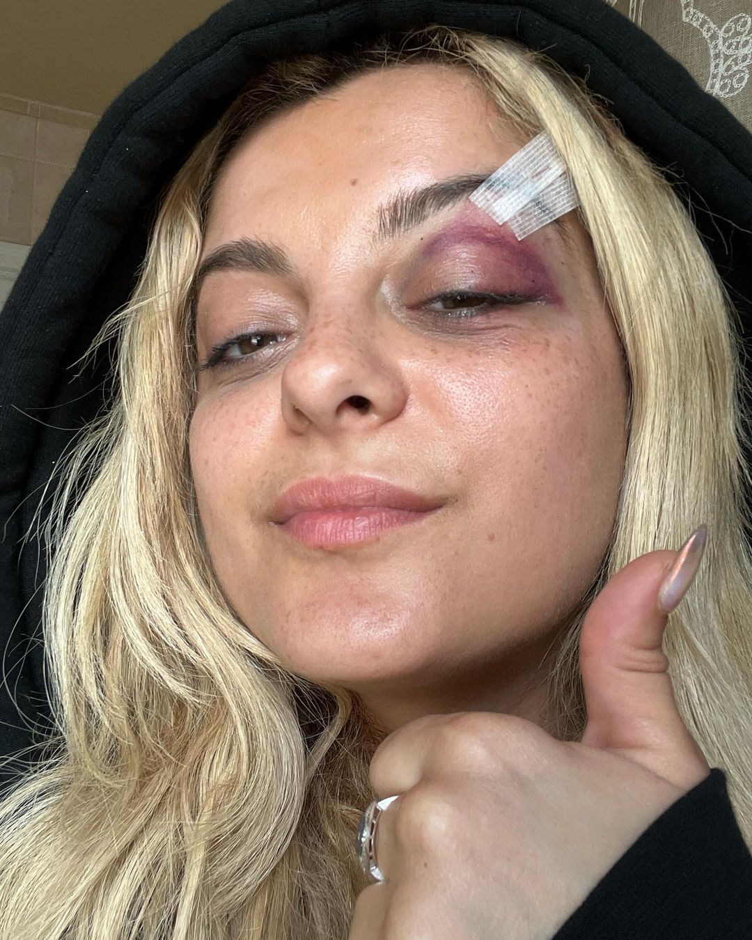 A Better Look at Bebe Rexha’s Black Eye!